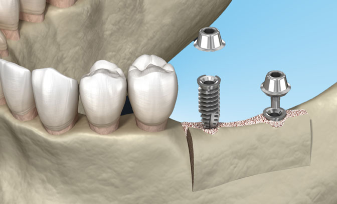 Bone Spreading/Bone Splitting Bild 1