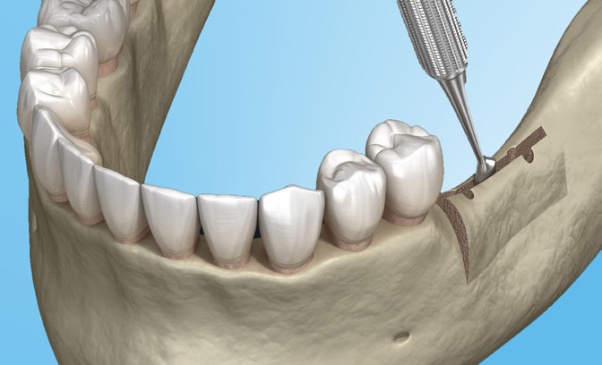 Bone Spreading/Bone Splitting Bild 2