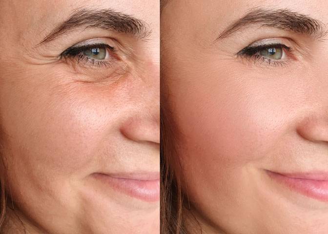 Botox Bild 2