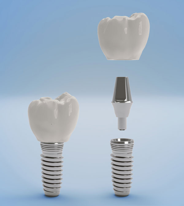 Zahnimplantate Bild 1